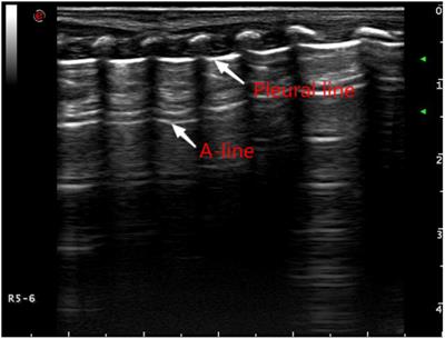 The Application of Pulmonary Ultrasound in Neonatal Ventilator-Associated Pneumonia